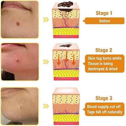 Bee Venom Mole and Wart Treatment Cream