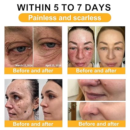Bee Venom Mole and Wart Treatment Cream